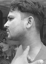 Joginder Singh shows his bruises in Panchkula on Sunday.