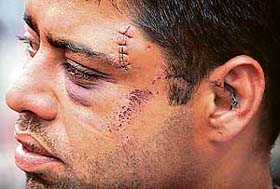 Indian attack victim Gurminder Singh pose for media at market in Doebeln