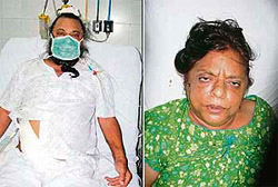 Gurdeep Singh who, received a new lease of life with a kidney donated by his sister Jaswant Kaur (right).