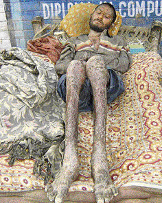 Mohan, suffering from HIV/AIDS, lies on a cot in the open outside the General Hospital, Fatehabad, demanding mercy death