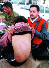 Krishan Lal shows the marks of brutality on his sons back.