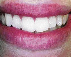 Dental jewellery does not need to be pre-treated