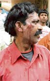 An injured person in a clash.