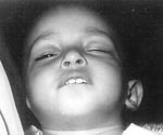 Lip biting at a very young age