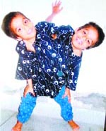 Conjoined twins Sohna and Mohna