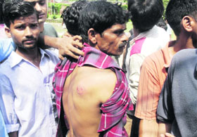 A protester shows the injury received in tear gas shelling.
