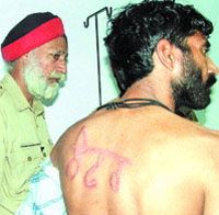 A jail inmate, Ashwani Kumar Bhola, shows his back where he has been branded Lofar in Amritsar. 