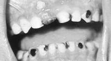 Those who take sweets more than thrice a day have more cavities in their teeth