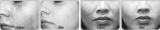 Over the years, there has been consistent improvement in techniques concerning various cosmetic and dermatological problems