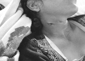 The woman, who was injured, undergoing treatment at a medical college and hospital near Patiala