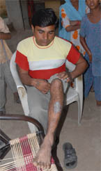 A resident of a village situated on the Indo-Pak border showing his skin problem. There are several persons in the villages of the areas suffering from skin disorders.