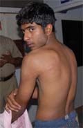 Love Kumar showing his injuries at the Kotwali police station in Bathinda on Thursday.