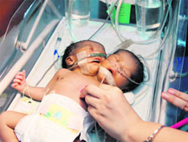 A nurse monitors the heartbeat of conjoined twins, named Girl Arciaga,  on Wednesday at a hospital 