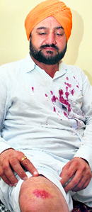 Bhupinder Singh Badheri, Congress candidate from ward No. 10, shows his injuries at his residence in Chandigarh on Tuesday.