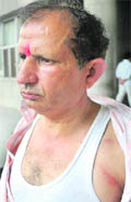 Badri Prasad, a resident of Sector 48, who was allegedly beaten up by a doctor and security guards at the GMCH-32, Chandigarh, on Tuesday. 