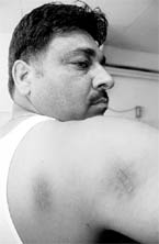 Sewa Singh shows injury marks on his body.