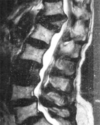 An X-ray picture showing multiple osteoporotic compression fractures in the spine of an 80-year-old woman