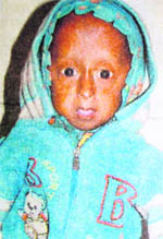 Four-year-old Amit of Jhunjhunu district in Rajasthan who has been suffering from progeria.