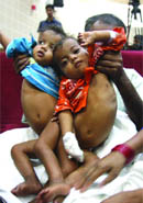 Conjoined twin sisters Sita and Gita at Batra Hospital in New Delhi on Tuesday.