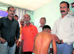 Mohammad Ahmad, father show the injuries on his face and back in Dehradun on Monday