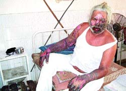 Assistant lineman Avtar Singh under treatment at the Civil Hospital in Tarn Taran