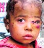 Sadhna (3), who was badly bitten by a feral dog in Fatehpur near Laddowal.