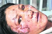 Rinchen Dolma from Chuglamser being treated at Army hospital at Leh.