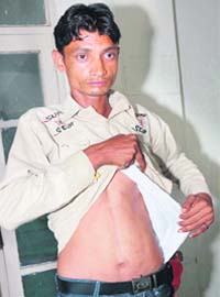 Shakti Singh shows his injury marks to mediapersons in Karnal