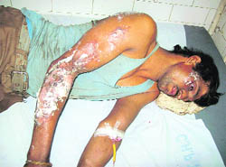 A labourer who was injured in the furnace blast at Kandori in Kangra on Friday. 