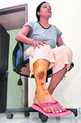 Shallu, a schoolteacher, shows her wounds in Ludhiana.