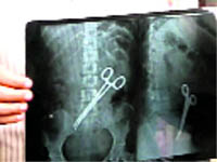 The X-Ray shows a pair of scissors left in the womans abdomen by a team of surgeons at Ludhiana.