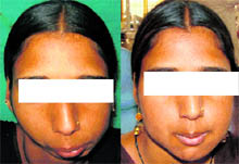 The girl whose chin has been reconstructed by Dr Nageshwar Iyer of the Maharishi Markandeshwar Medical Institute of Sciences and Research