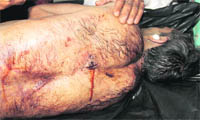 A gunshot wound (encircled) at the back of the deceased Sub-Inspector.