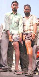 Protesters show injuries after a cane charge by the police. 