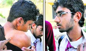 Saurabh and Sanjay, both students of Government Multipurpose School, Cemetery Road, show injury marks after they were allegedly thrashed by a teacher