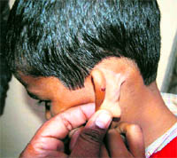 A student shows an injury mark on his ear in Haridwar on Tuesday.