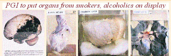 From left: Haematomic brain, fatty heart, cirrhotic liver and smokers lung on display at the anatomy department of the PGI in Chandigarh. Tribune photographs