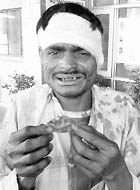 A migrant labourer shows his chopped ear at the general hospital, Sector 6, Panchkula, on Monday.