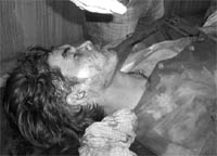 One of the injured of the blast in a godown at the Civil Hospital, Mandi Gobindgarh, on Saturday
