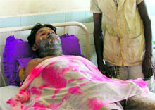 Ajay Kumar, a patient with burns, lying in the male ward of the Civil Hospital in Ludhiana