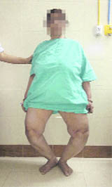 Asha, whose knees were deformed after treatment from a quack