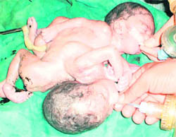 The Siamese twins born at a hospital in Fatehabad 