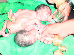  A file photo of the Siamese twins at Fatehabad
