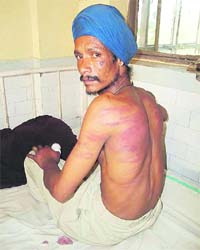 Bahadar Singh shows bruises on his back