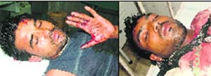 Injured Jaswinder and Sonu at the Civil Hospital in Jalandhar