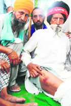 Teja Singh shows injury marks on his leg. 