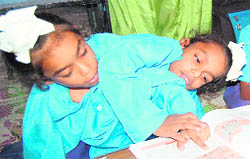 Eight-year-olds Sona and Mona are conjoined twins.