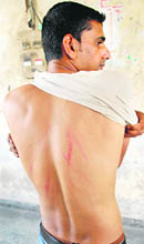 Vipan Sharma, driver of Labour Commissioner, shows injuries marks on his back.