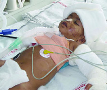 Baby Falak at AIIMS Trauma Centre