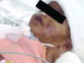 Baby Falak at the AIIMS Trauma Centre